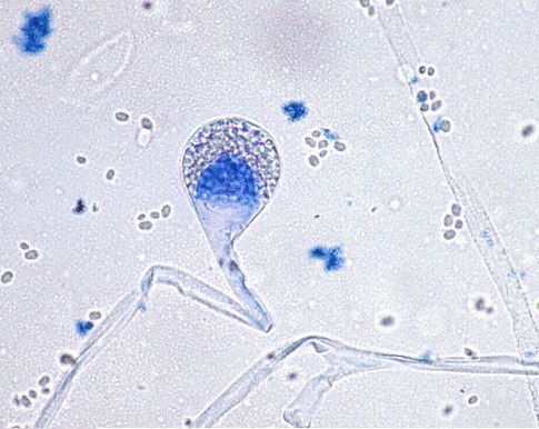 Absidia Corymbiferain an immune competent accident victim with multiple ...