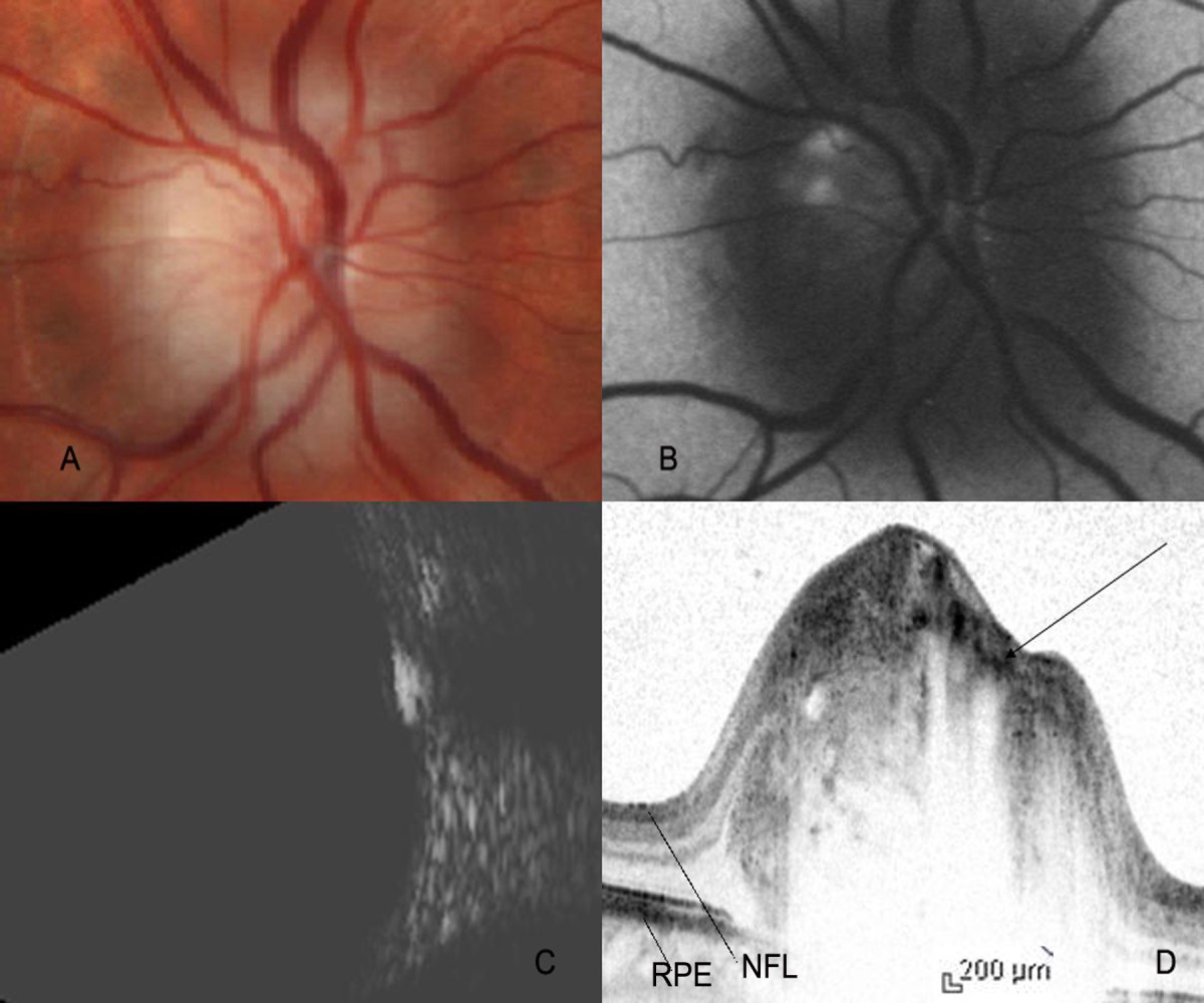 Invivo high resolution imaging of optic nerve head drusen using