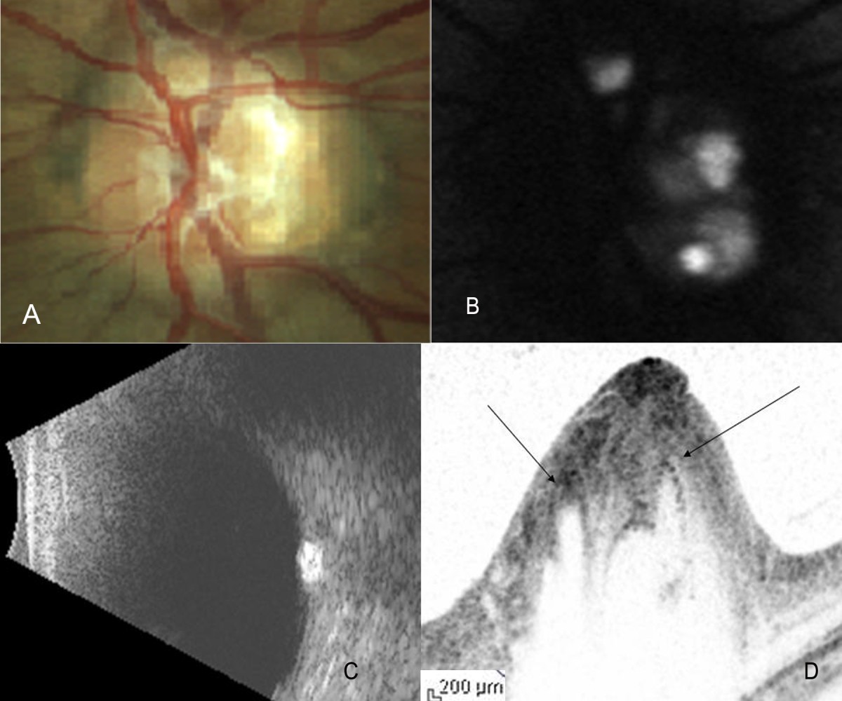 Invivo high resolution imaging of optic nerve head drusen using