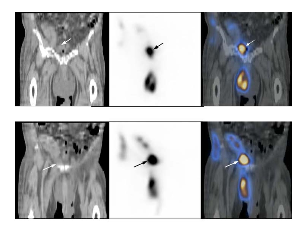 Extraperitoneal urine leak after renal transplantation the role of