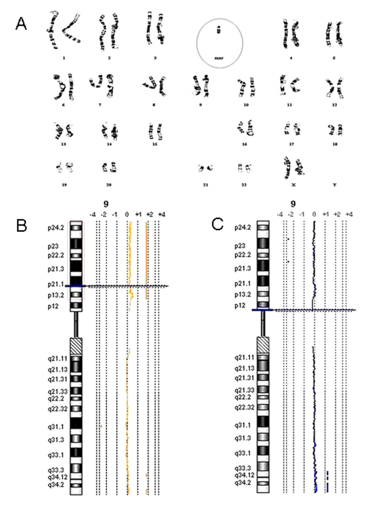 A de novo marker chromosome derived from 9p in a patient with 9p
