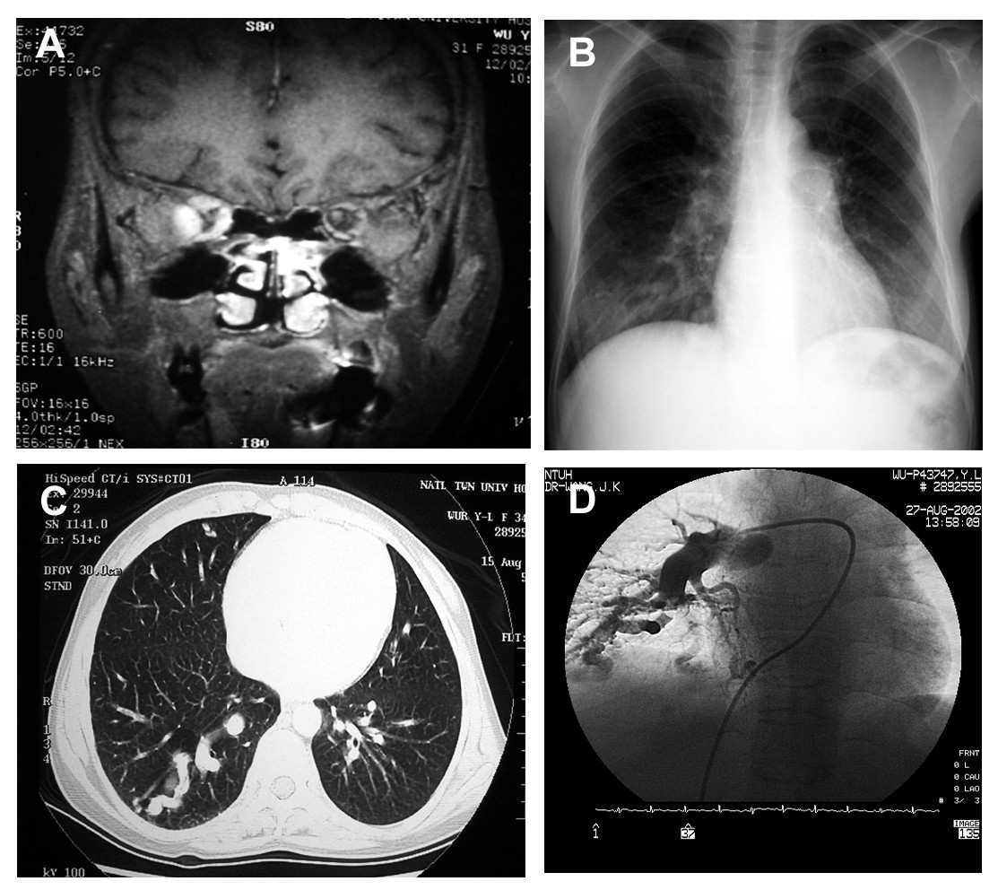Type I Gaucher disease with exophthalmos and pulmonary arteriovenous