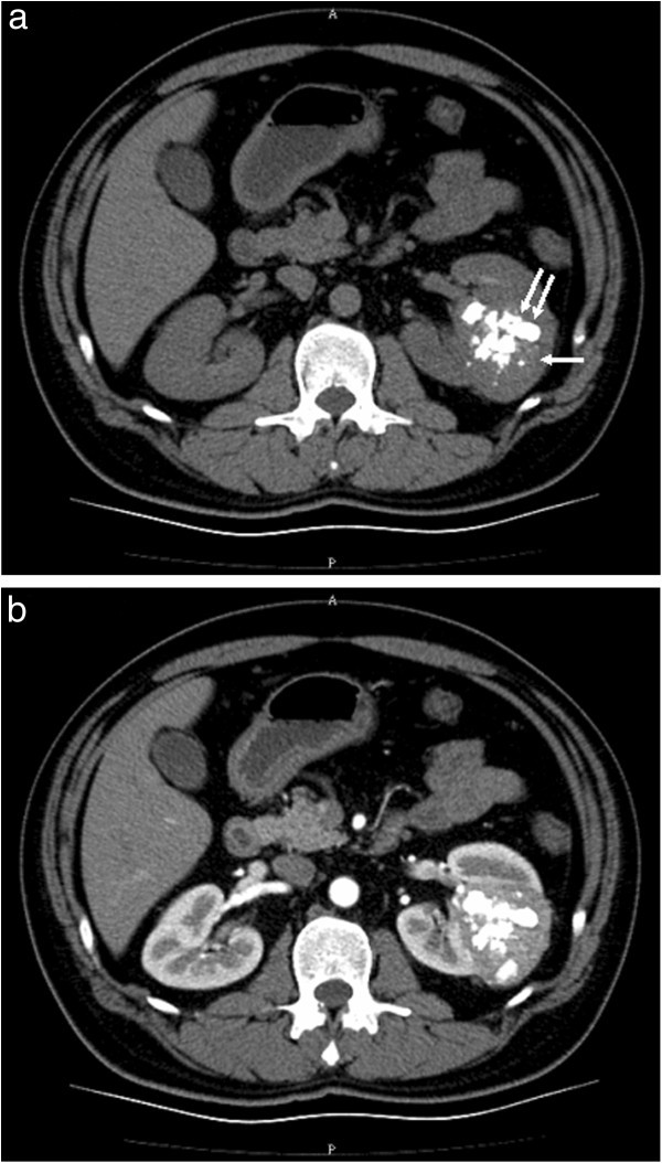 Calcified, minimally Fat-contained angiomyolipoma clinically ...