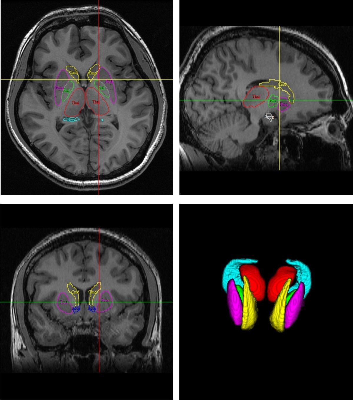 Evaluation of subcortical grey matter abnormalities in patients with