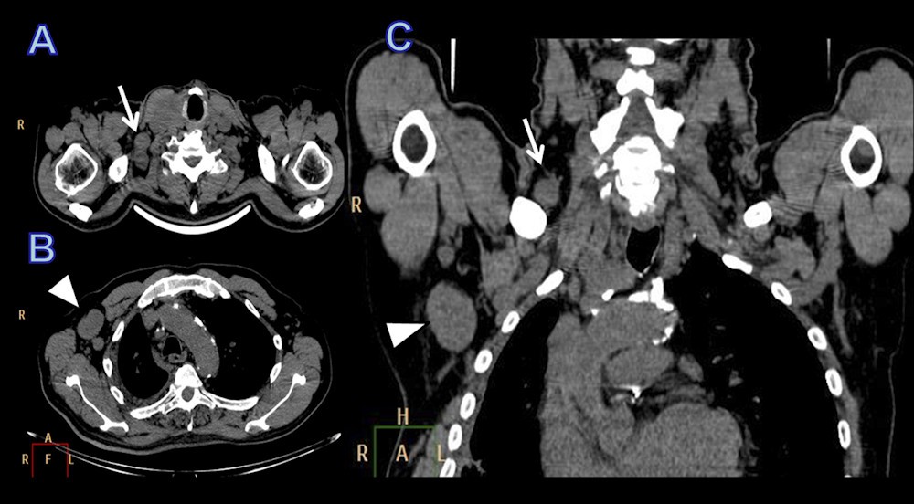 Axillary node metastasis from differentiated thyroid carcinoma with