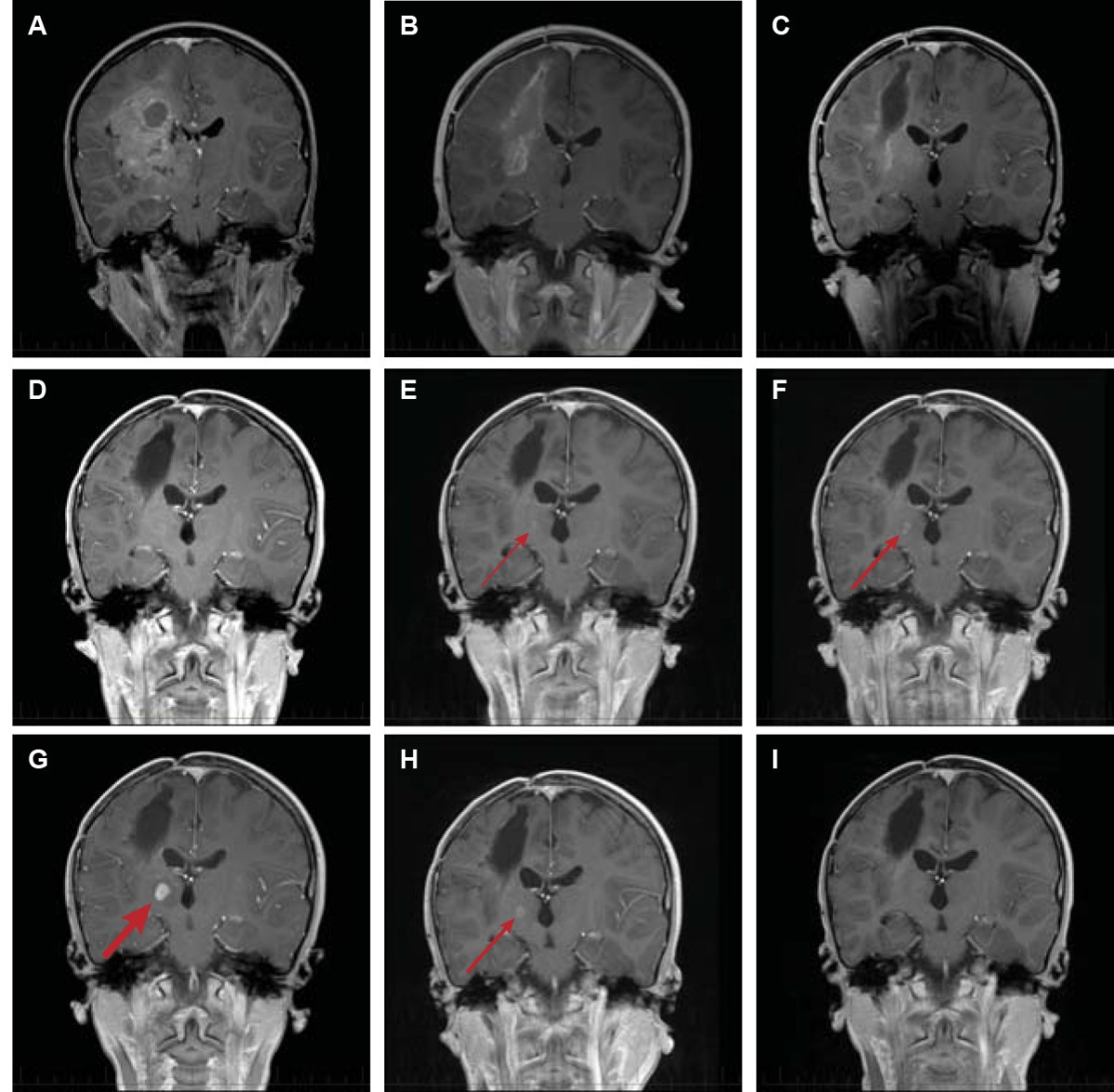 Complete clinical regression of a BRAF V600Emutant