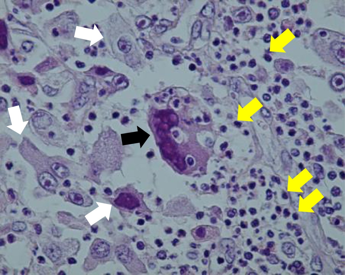 A pleomorphic carcinoma of the lung producing multiple