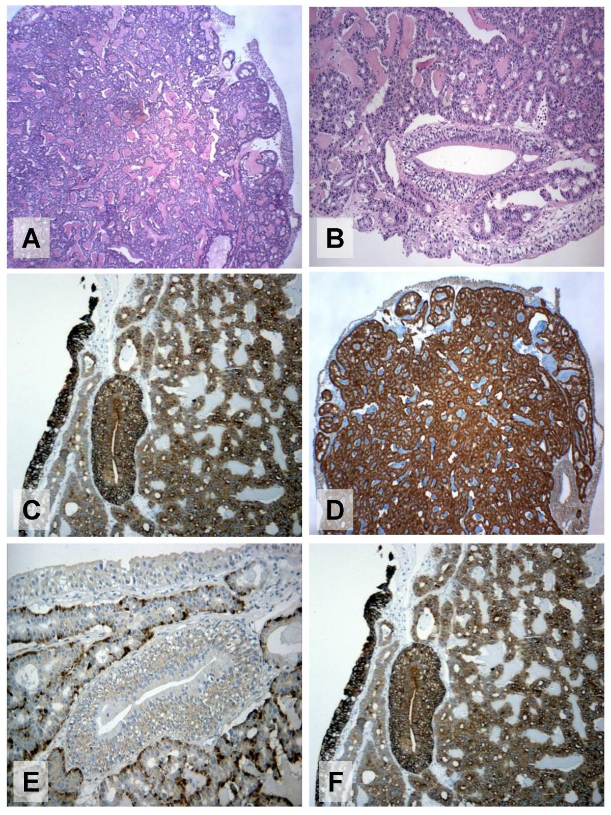 Calcitoninproducing welldifferentiated neuroendocrine carcinoma