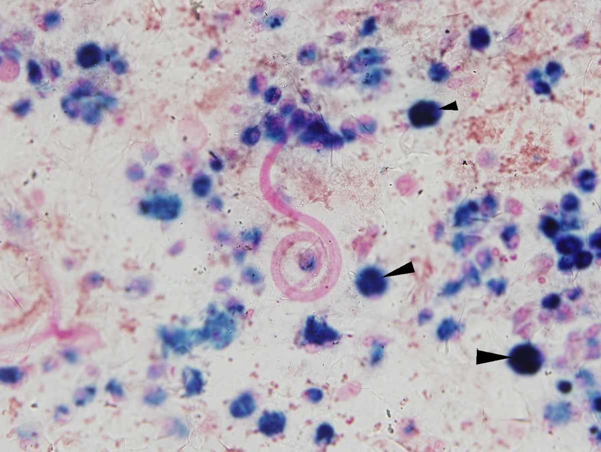 An unusual cause of alveolar hemorrhage post hematopoietic 