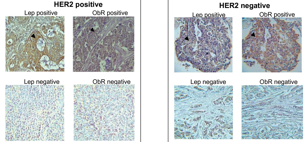 Leptin/HER2 crosstalk in breast cancer in vitro study and