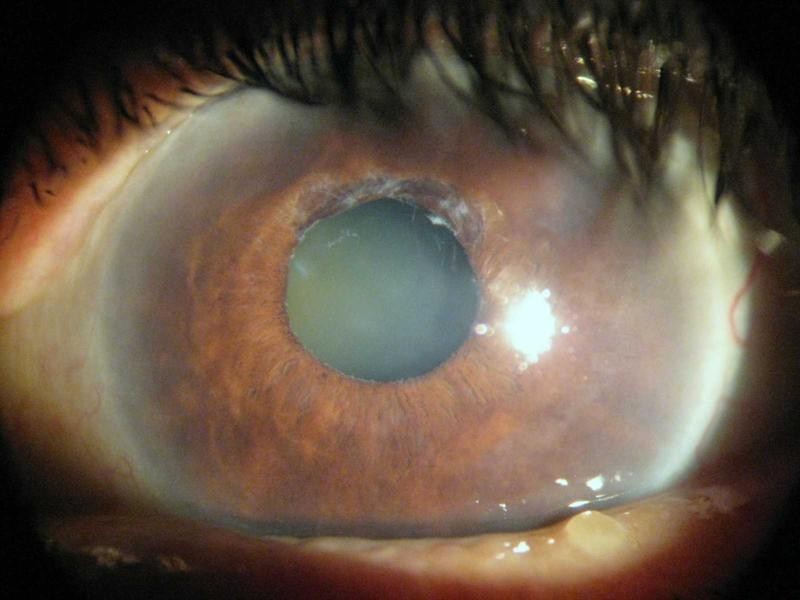 Prevalence of Pseudoexfoliation Syndrome and Pseudoexfoliation