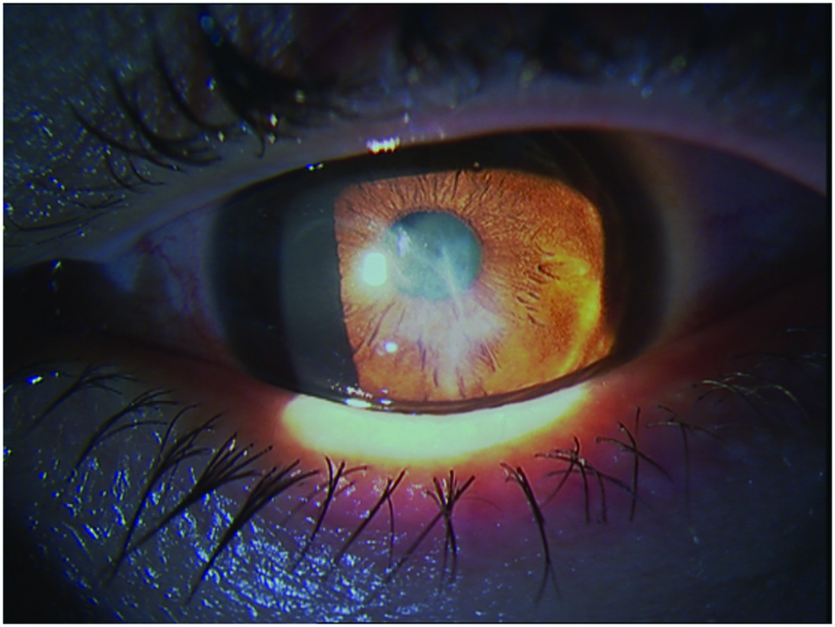 A case of bilateral selfinduced keratoconus in a patient with tourette