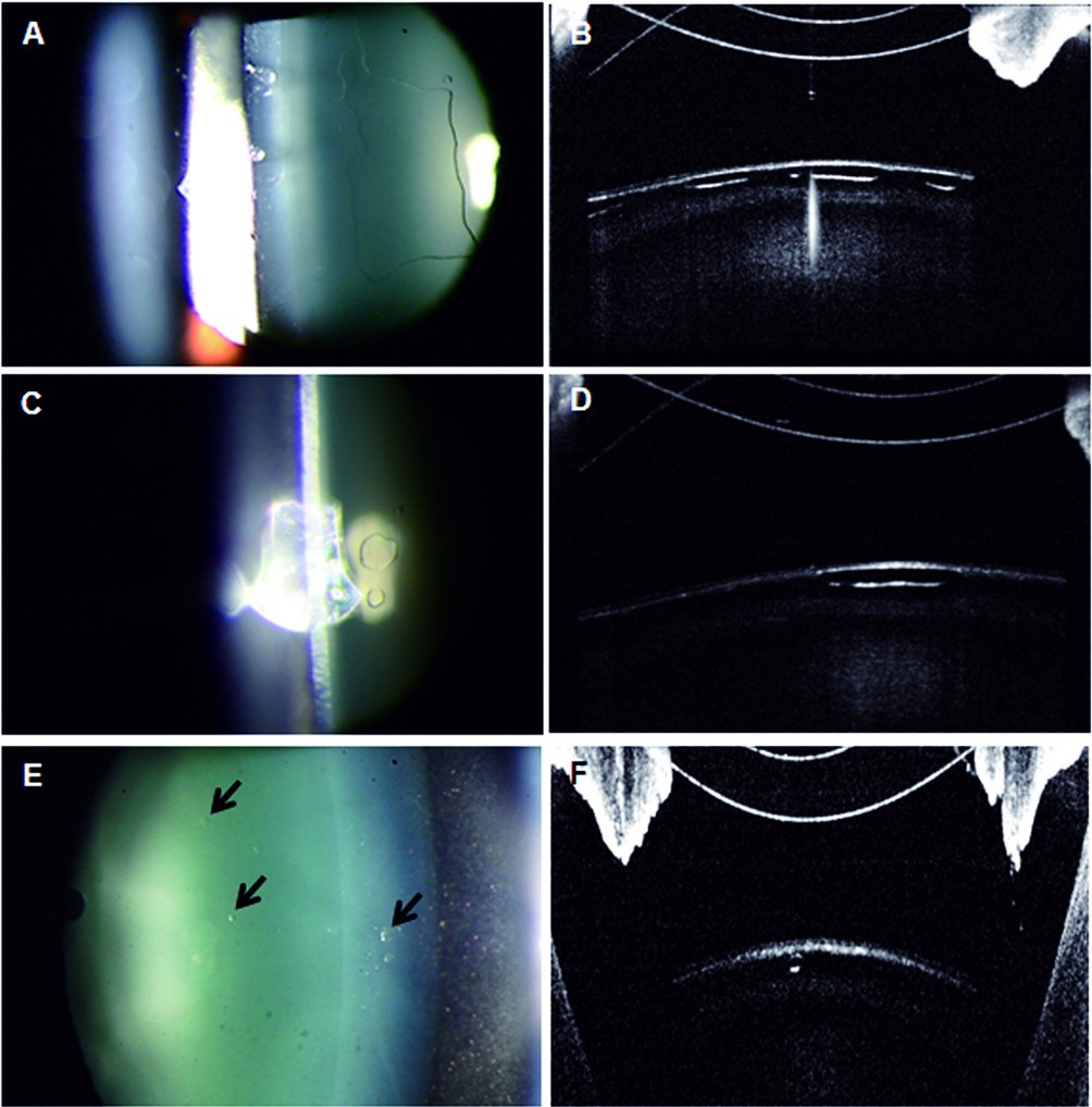 Transient anterior subcapsular vacuolar change of the crystalline lens