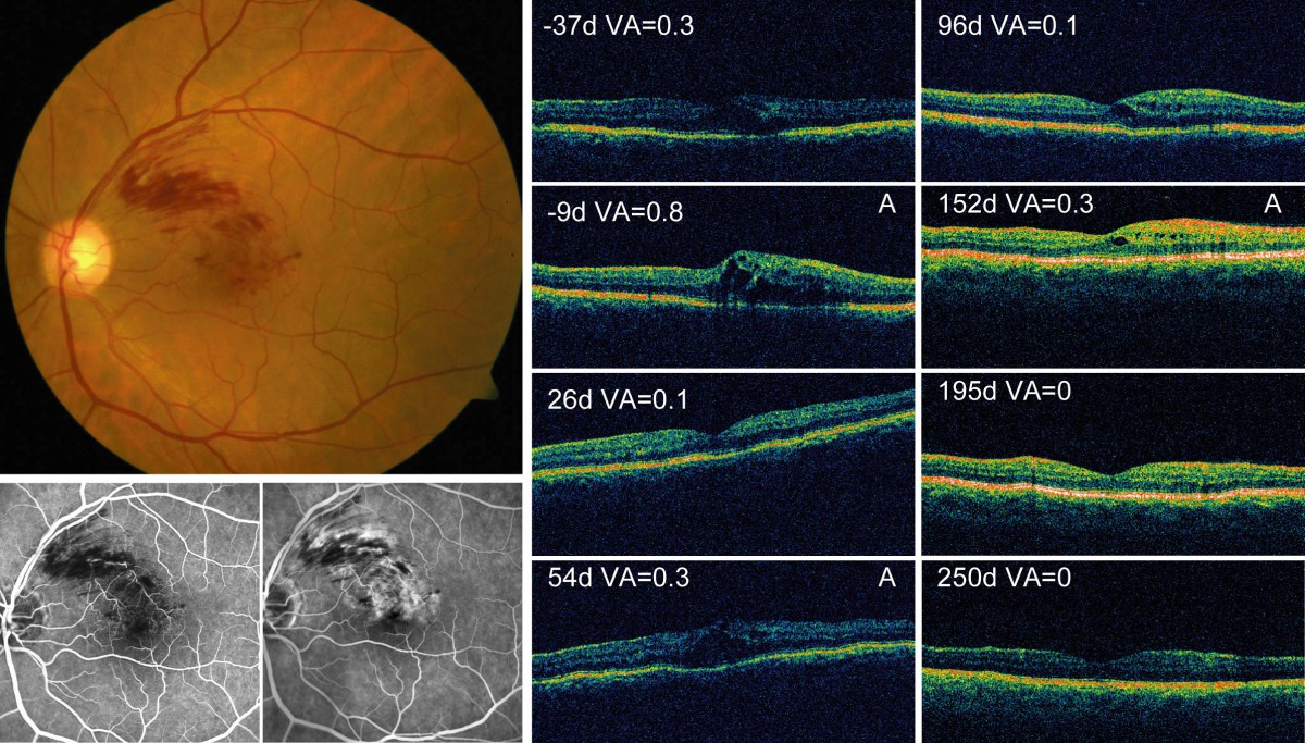 eye test 0.9 Vein Branch Retinal Treatment Macular of induced Occlusion eye test 0.9 Vein Branch Retinal Treatment Macular of induced Occlusion