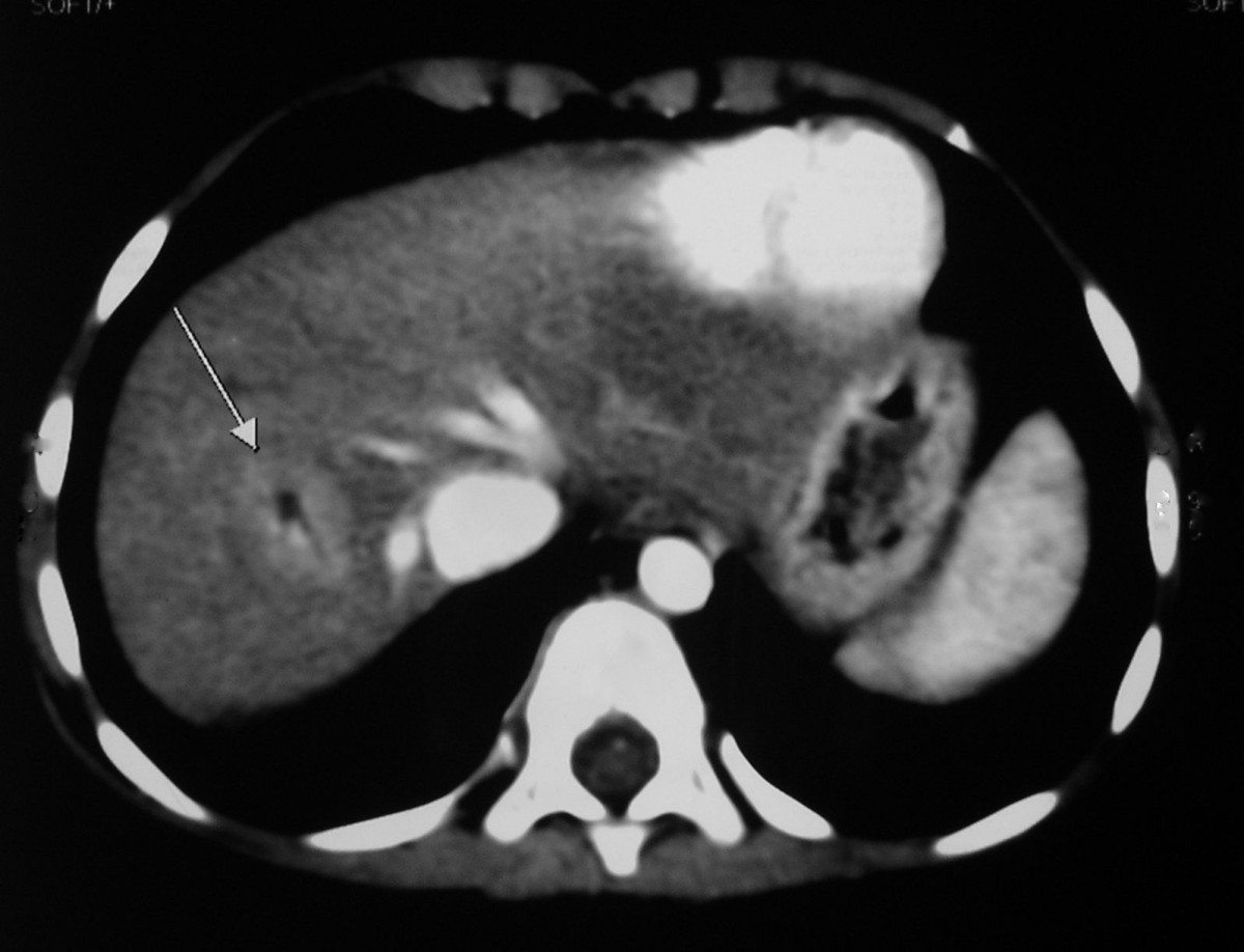 malformation a case report BMC Pediatrics Full Text