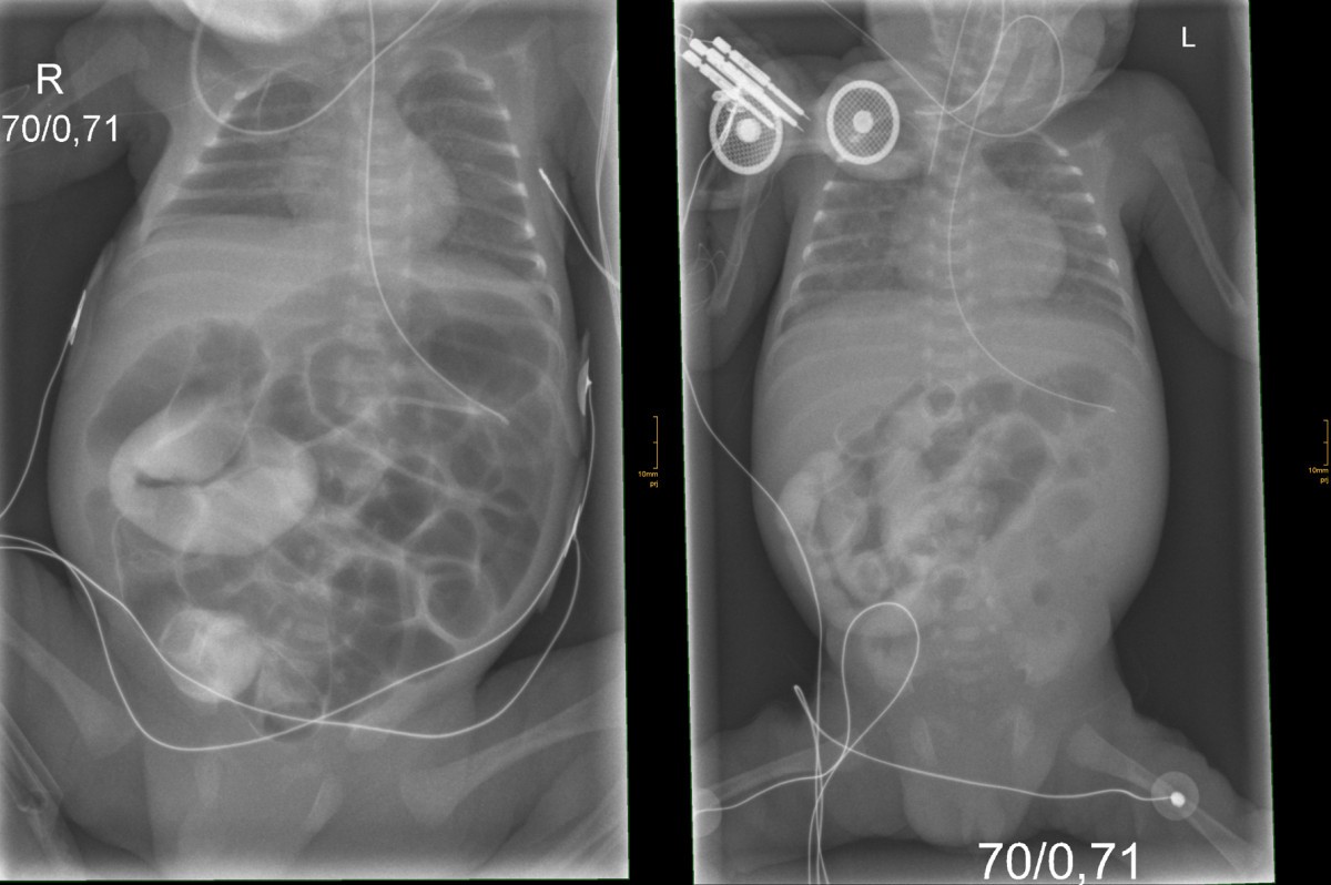 Lethal course of meconium ileus in preterm twins revealing a novel