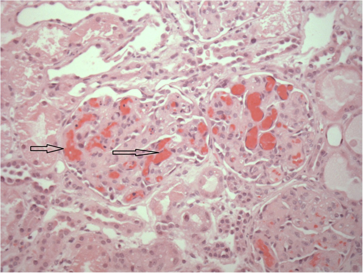 Hemolytic uremic syndrome with simultaneous Shiga toxin producing ...