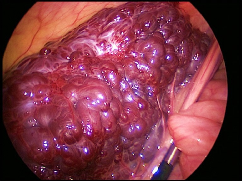 Large, segmental, circular vascular malformation of the small intestine