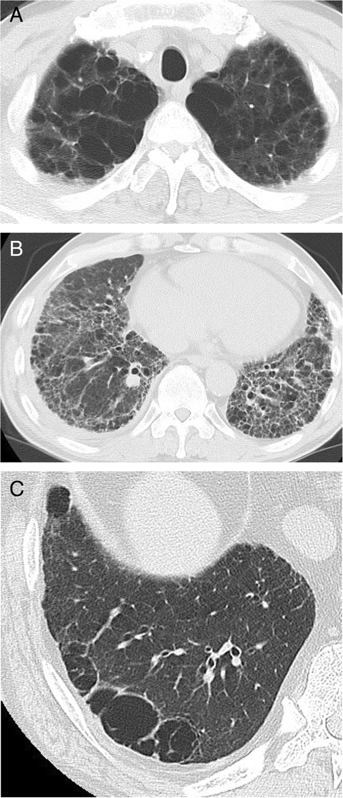 An autopsy study of combined pulmonary fibrosis and emphysema