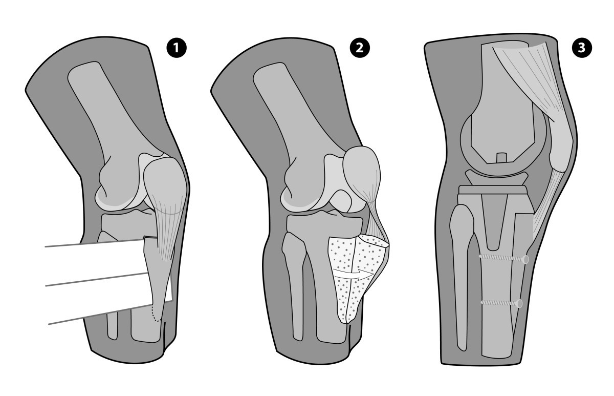 Anterolateral approach with tibial tubercle osteotomy