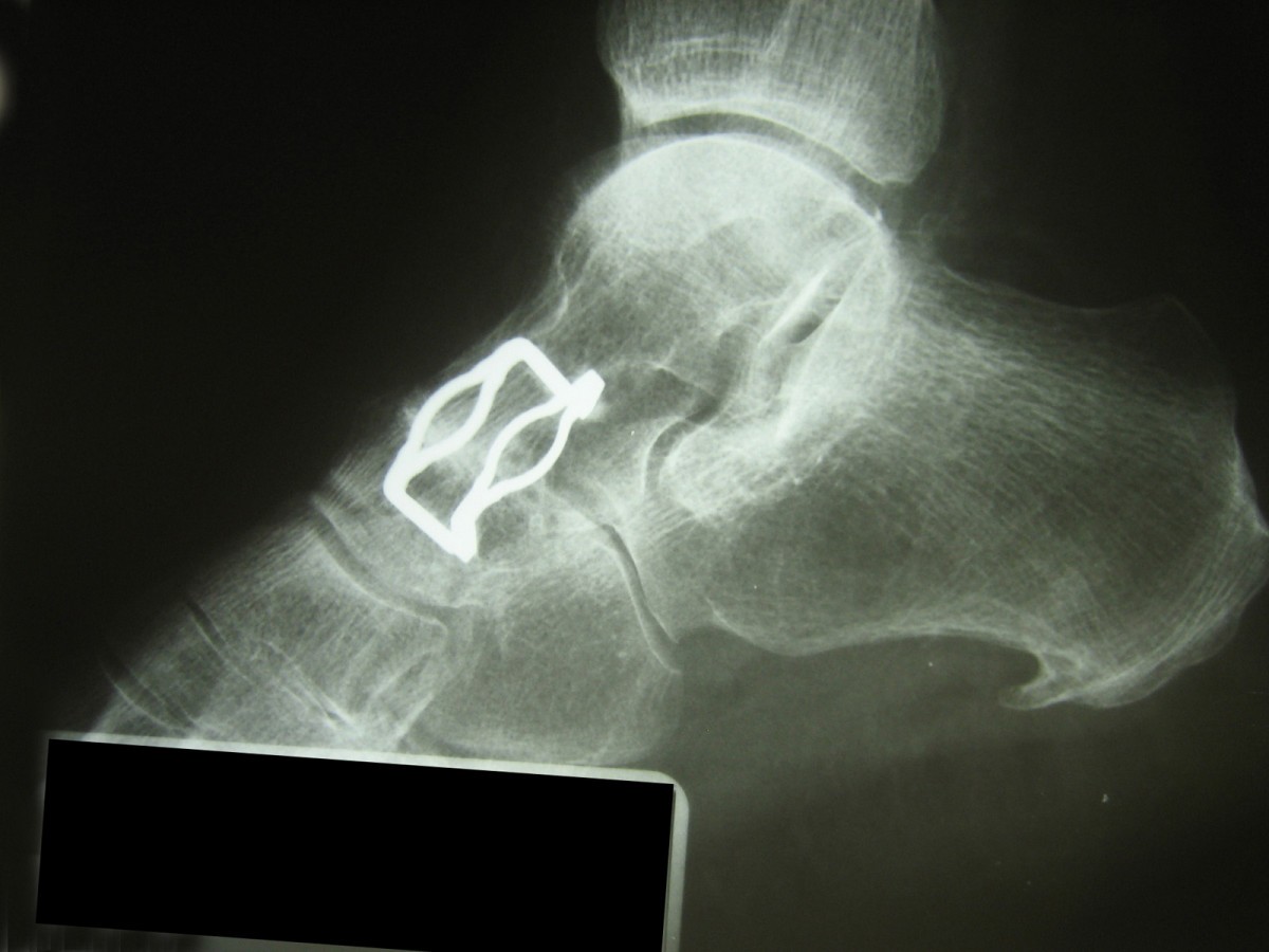 Isolated talonavicular arthrodesis in patients with