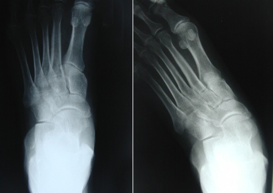 Isolated talonavicular arthrodesis in patients with rheumatoid