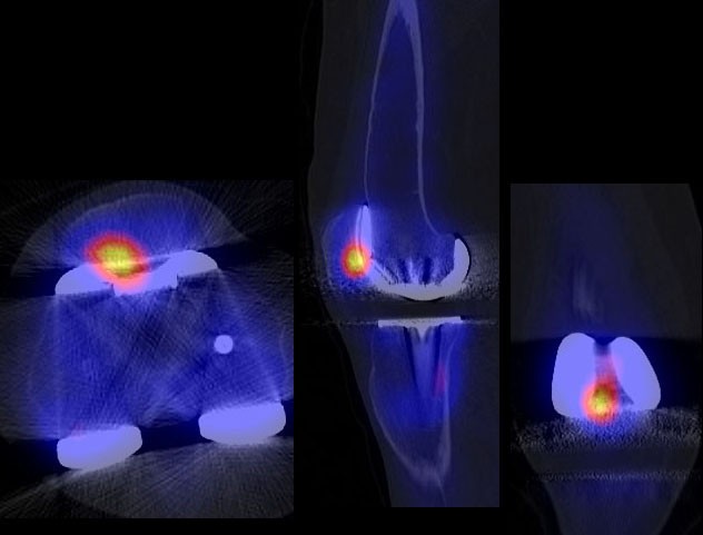 Clinical value of SPECT/CT for evaluation of patients with painful ...