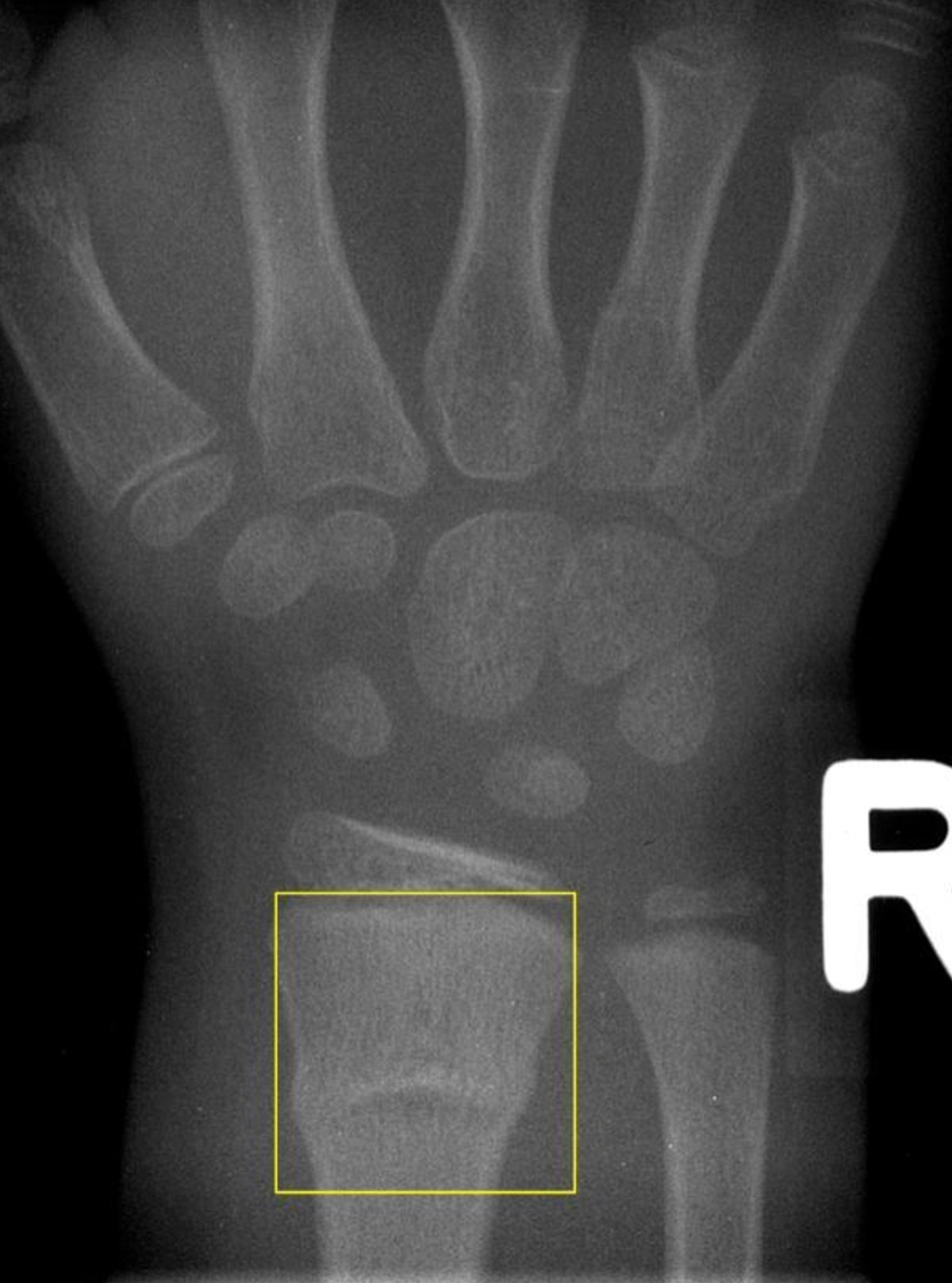 Development and validation of a paediatric long-bone fracture