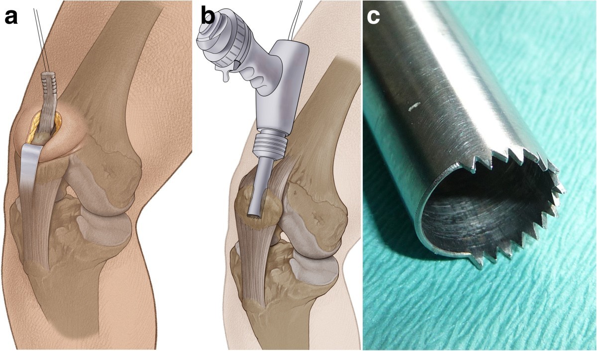 Anterior cruciate ligament (ACL) reconstruction with quadriceps tendon