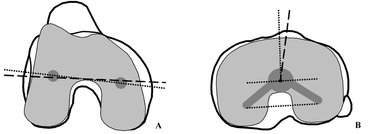 Tibia Rotational Alignment Rotations Ct Nach Berger – Tibial Rotational Alignment in Total Knee ...