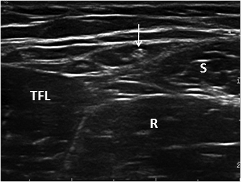 Ultrasound of the lateral femoral cutaneous nerve in asymptomatic