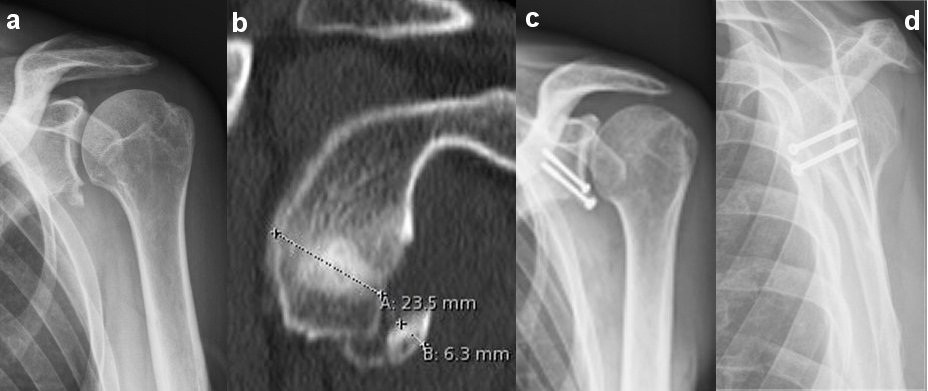 Evaluation of a treatment algorithm for acute traumatic osseous Bankart