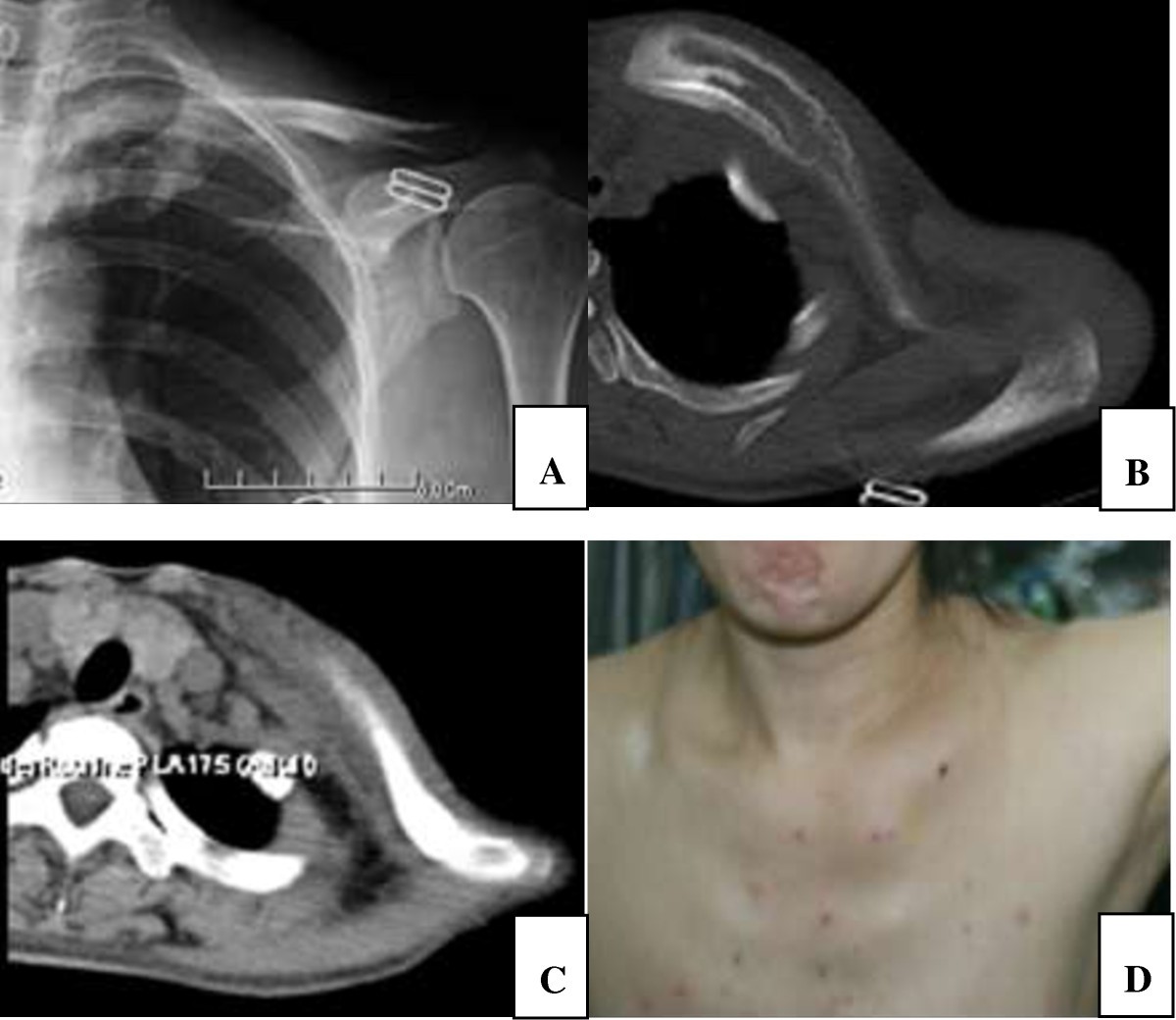 of bone defect reconstruction with clavicle bone cement prosthesis after tumor resection