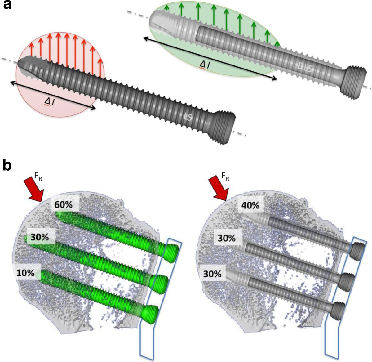 Dynamiclockingscrew (DLS)leads to less secondary screw perforations