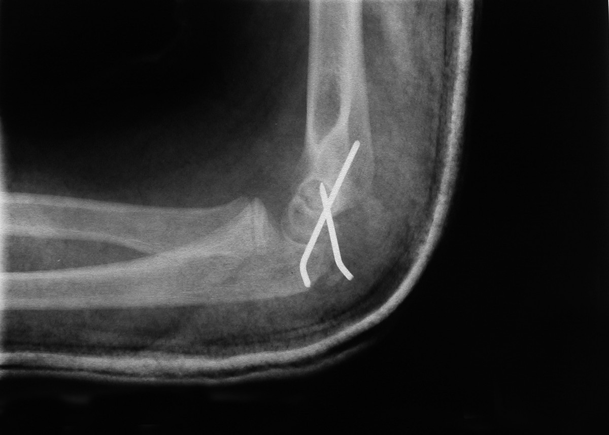Complex Pediatric Elbow Injury An Case BMC Musculoskeletal