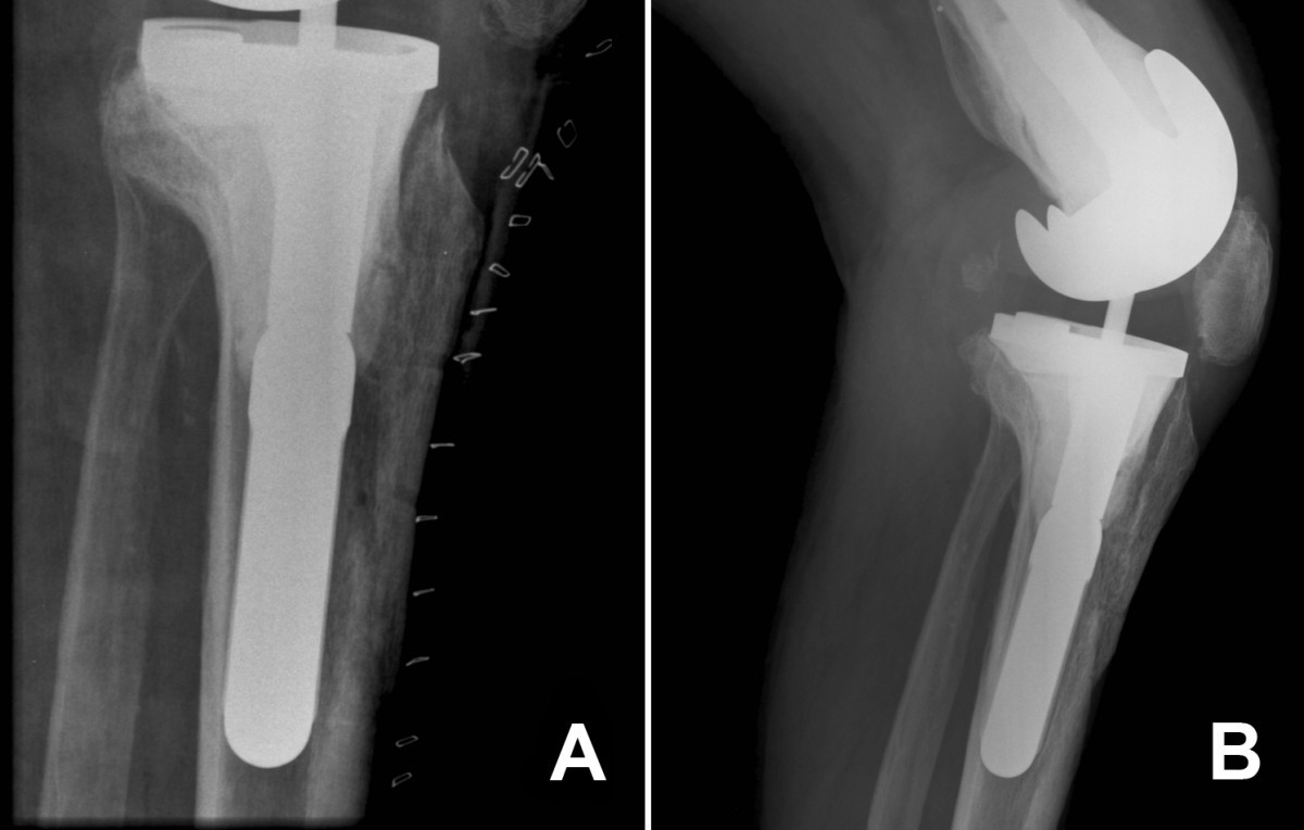 Tibial tubercle osteotomy for access during revision knee arthroplasty