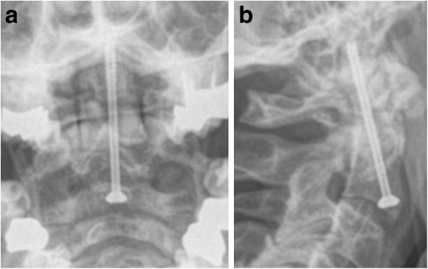 odontoid fracture type 1 odontoid fracture type 1