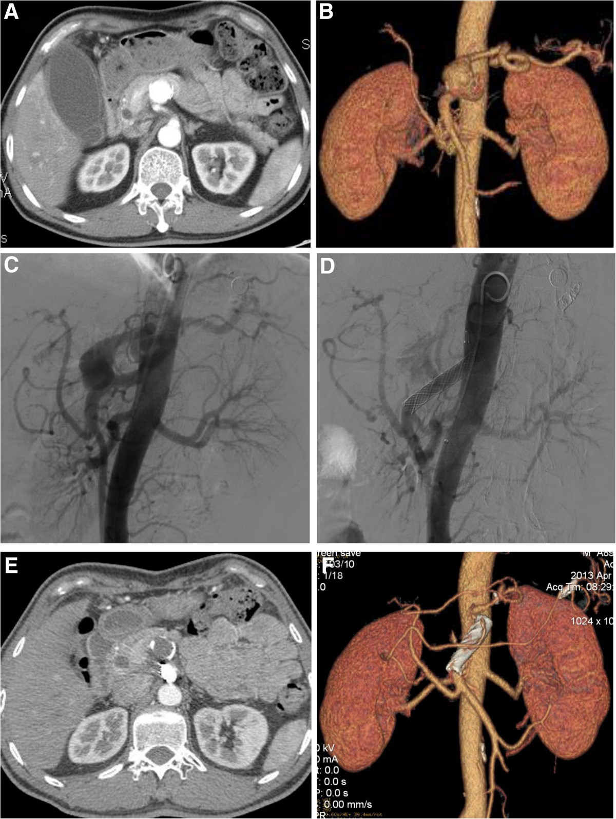 Successful treatment of aberrant splenic artery aneurysm with a