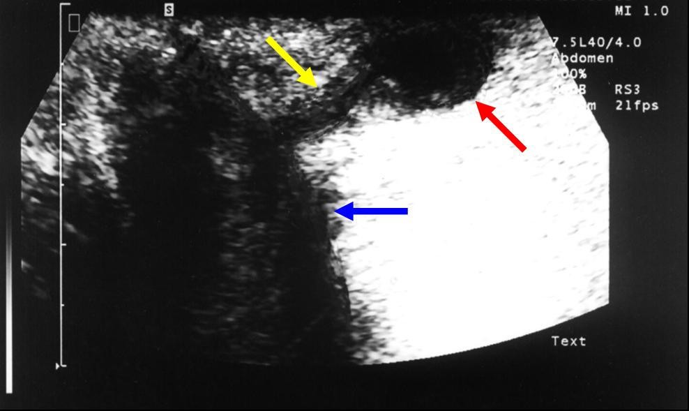 Fistulotomy and drainage of deep postanal space abscess in the treatment of posterior horseshoe