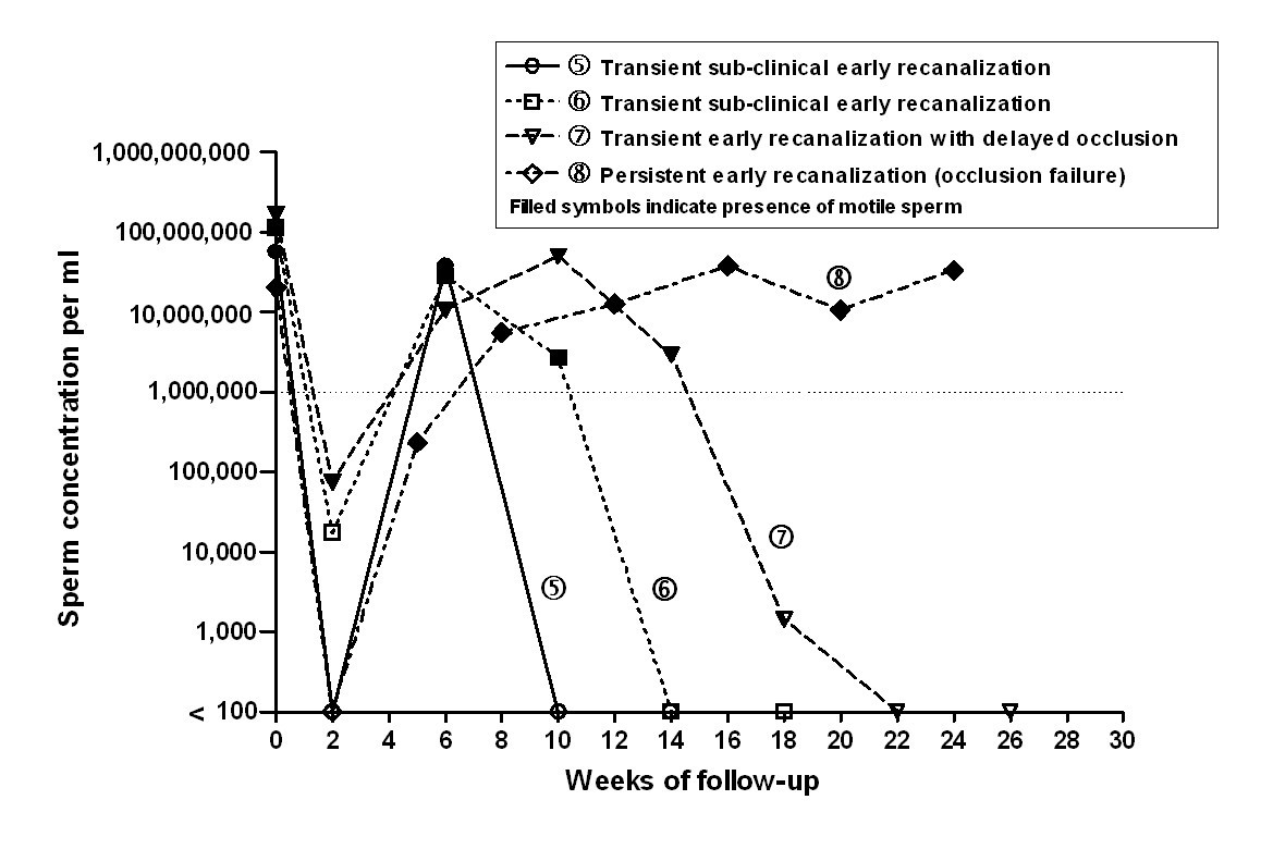 Frequency and patterns of early recanalization after vasectomy BMC