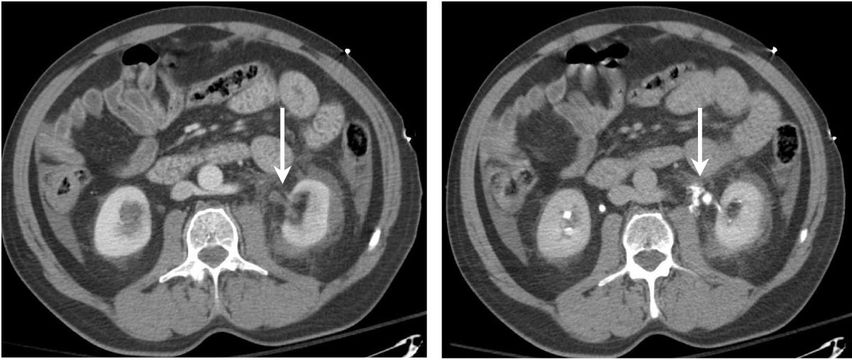 CT scanning for diagnosing blunt ureteral and ureteropelvic junction