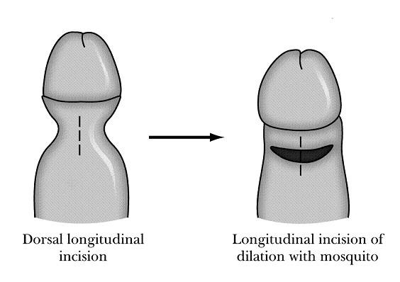 pictures of skin tags on penis underskin pictures of skin tags on penis underskin