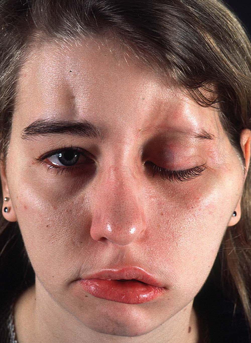 Bilateral linear scleroderma "en coup de sabre" associated 