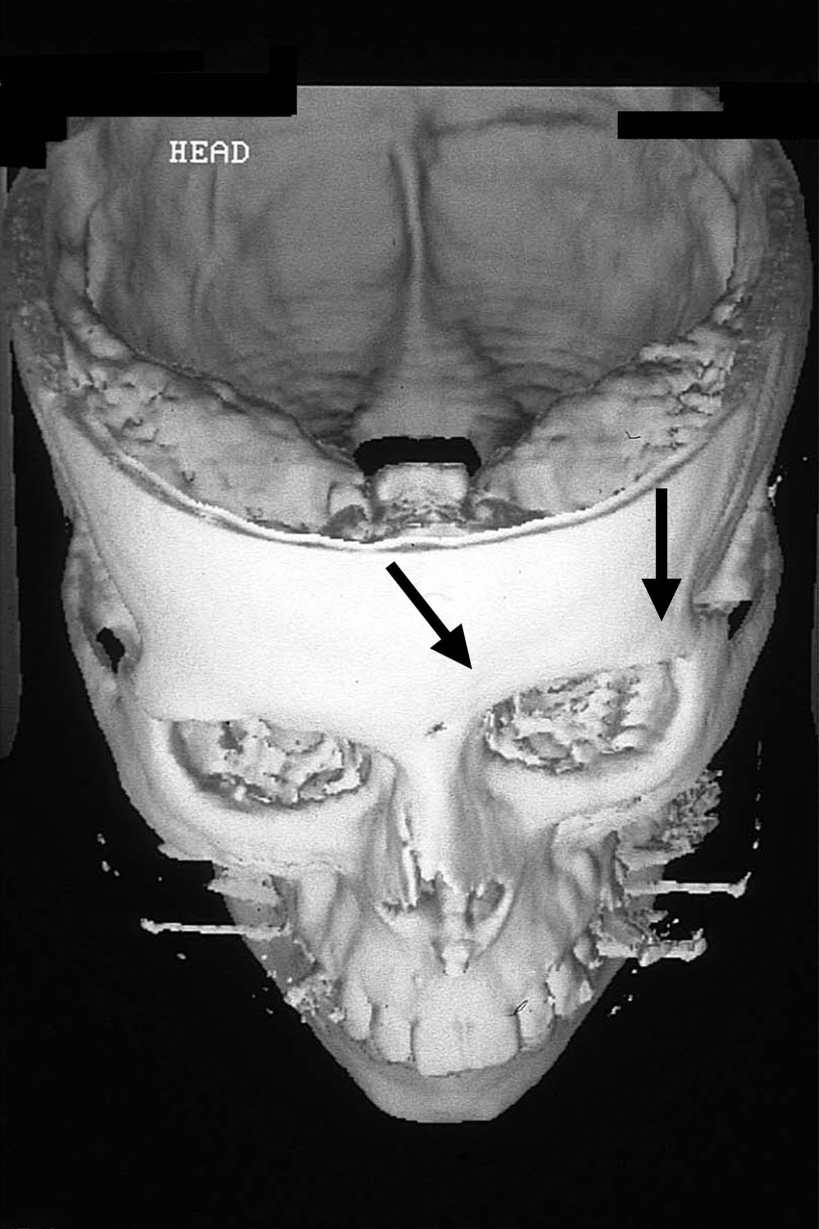 Bilateral linear scleroderma "en coup de sabre" associated with facial atrophy and neurological