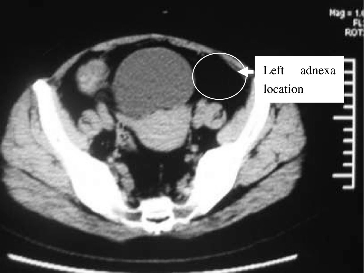 15+ Adnexal Mass Mri Pics