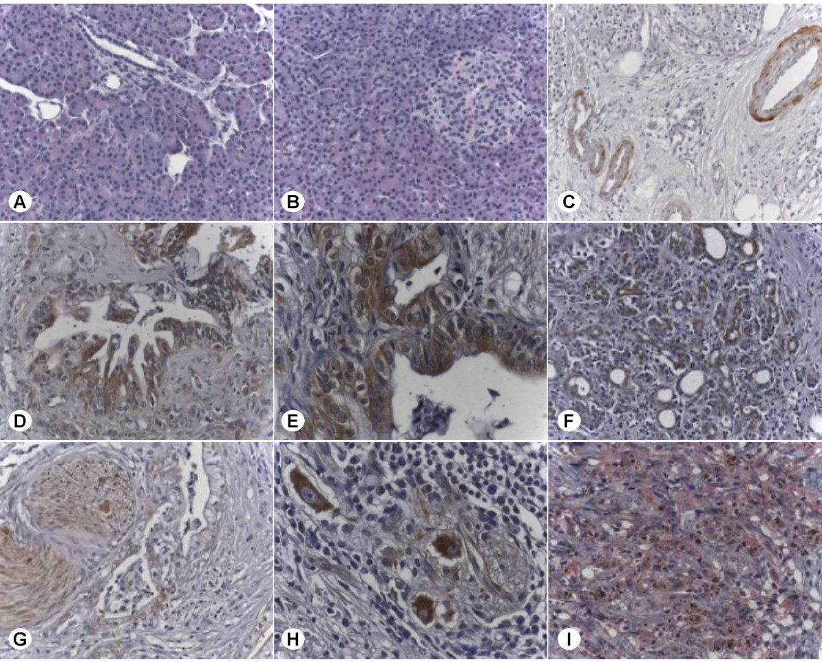 Melanoma Inhibitory Activity (MIA) increases the invasiveness of