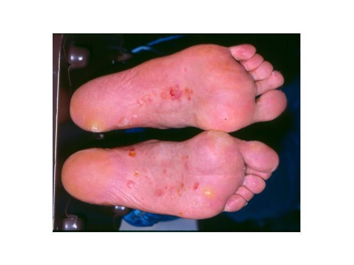 Dermatology for the practicing allergist: Tinea pedis and its