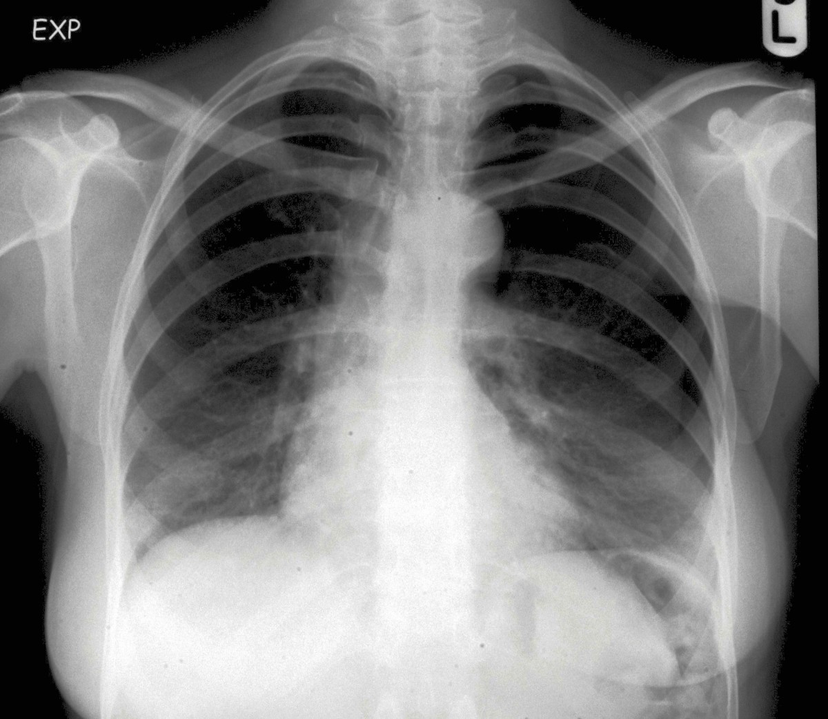 Pneumothorax after a clinical breast fineneedle aspiration of a lump