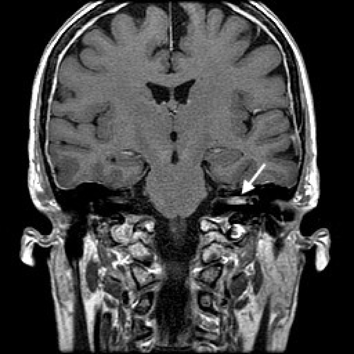 mr of th e normal and abnormal internal auditory canal mr of th e normal and abnormal internal auditory canal