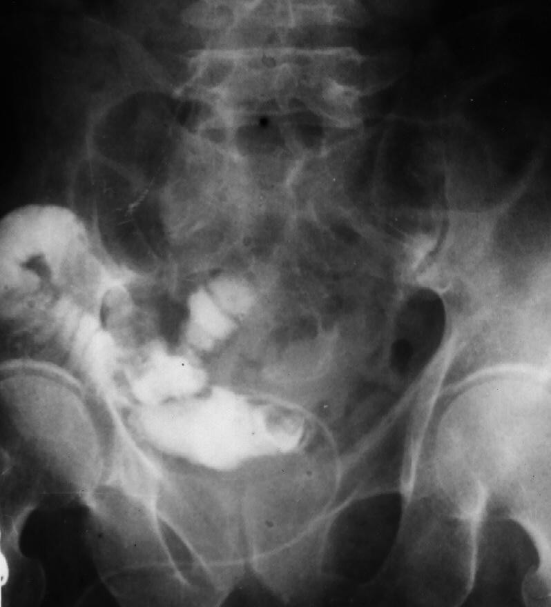 Spontaneous Enterocutaneous Fistula 27-years Following ...